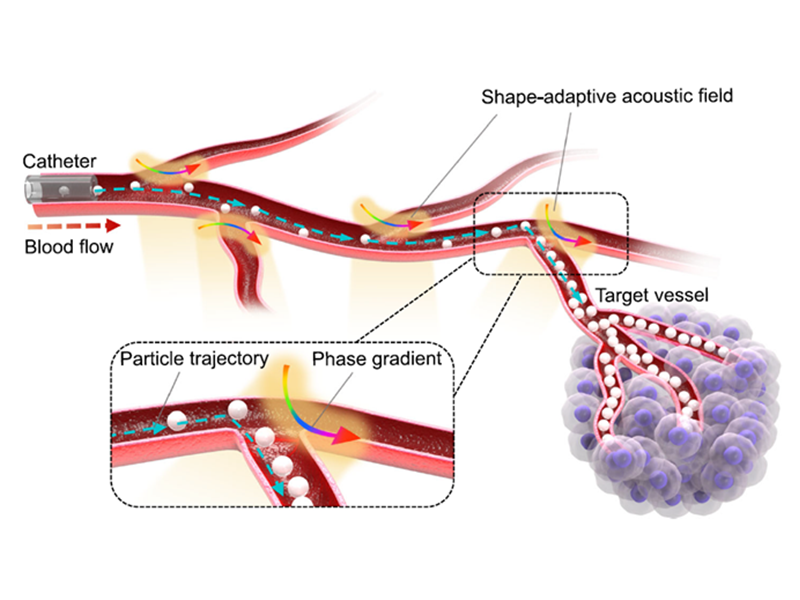 上海交大马智超团队提出基于超声微粒操控的高选择性血管栓塞术